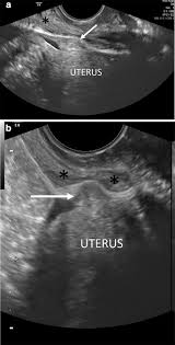 The female pelvis is routinely evaluated with at least one of two ultrasound techniques: Ultrasound Evaluation Of Deeply Infiltrative Endometriosis Technique And Interpretation Springerlink