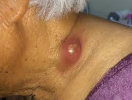 Tuberculosis is an often fatal but now extremely rare and treatable infectious disease. Cutaneous Tuberculosis Dermnet Nz