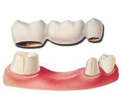 I M Looking To Get A Dental Bridge To Replace A Tooth What Are The Different Types And How Do I Choose Smile Solutions