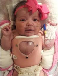 Ectopia Cordis by jaidenmcalister