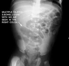 Image result for Adynamic Ileus
