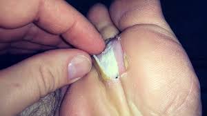 как вывести сухой мозоль со стержнем на пальце ноги Udalit Natoptysh Mozol Na Noge Stope Pyatke Salipodom Youtube