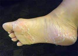 Under the skin / cast Dead Skin Under Cast