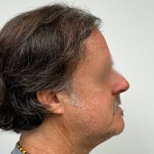 Fort Lauderdale Hair Transplants & Restoration