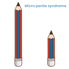 Micro penile syndrome (Small penis problem) | Metromale Clinic & Fertility  Center