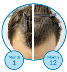This is different from male pattern baldness which is genetic and not a disor. What Are My Options For A Thinning And Receding Hairline