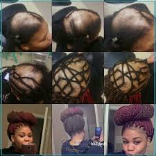 Natural Hair Glory Photo Natural Hair Styles Hair Styles Alopecia Hairstyles