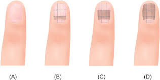 Image result for Muehrcke Line