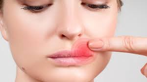 Erst dann erscheinen die unschönen blasen an. Was Hilft Gegen Herpes Praktische Tipps Stern De