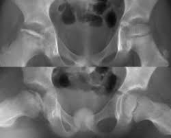 Image result for Pediatric Limp