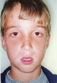 Contribuição multidisciplinar no diagnóstico e no tratamento das obstruções  da nasofaringe e da respiração bucal