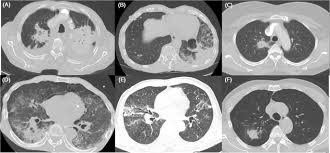 Tuberculosis (tb) is 100% curable if treated with the approved four drug combination for a minimum of six months. Pulmonary Tuberculosis Presenting Secondary Organizing Pneumonia With Organized Polypoid Granulation Tissue Case Series And Review Of The Literature Bmc Pulmonary Medicine Full Text