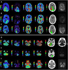 Image result for Posterior Circulation