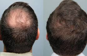 A subject with severe aa (patient 4 in table 1) achieved complete. Stem Cell Therapy For Hair Regrowth Stem Cell Therapy Sparha Advanced Wellness Studio Bengaluru Id 20358915962