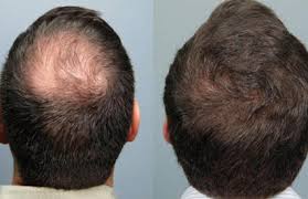 This treatment has no barriers and is effectively used to treat men and women suffering from hair loss. Stem Cell Therapy For Hair Regrowth Stem Cell Therapy Sparha Advanced Wellness Studio Bengaluru Id 20358915962
