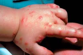 Image result for Fire Ant Sting