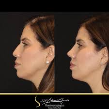 La rinoplastía está diseñada para realzar la forma y función de tu nariz,  siempre respetando tu naturalidad. ✨ ¿Qué esperas para agendar tu cita y  dar el siguiente paso hacia tu mejor