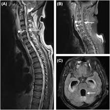 Image result for Spinal Epidural Abscess