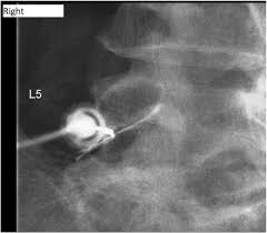 In the case of a new disc herniation, injections may be only weeks apart with a goal of quick and complete resolution of symptoms. Epidural Steroid Injection Vs Spinal Manipulation Revive Chiropractic The Pottsville Chiropractor