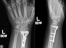 Ulnar Impaction Syndrome: A Case Series Investigating The Appropriate  Diagnosis, Management, And Post-Operative Considerations