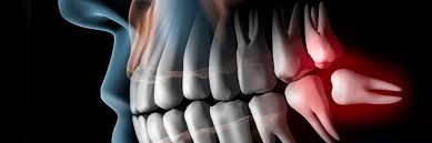 Der weisheitszahn (synonyma dritter molar, lateinisch dens sapiens, dens serotinus ‚spät kommend') ist von der mitte aus gezählt der achte zahn im menschlichen gebiss. Weisheitszahn Op Ablauf Risiken Kosten