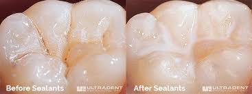 Sealing grout with an applicator. Alpharetta Dental Sealants Milton Teeth Seaing Cumming Ga