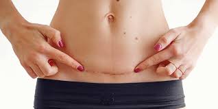5 Ways To Help Your C Section Heal Properly Greater Living Gbmc Healthcare