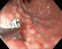 How much you can expect to pay out of pocket for a colonoscopy, including what people paid. Colorectal Cancer Amboss