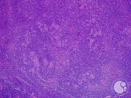 Nodular Lymphocyte Predominant Hodgkin Lymphoma 5