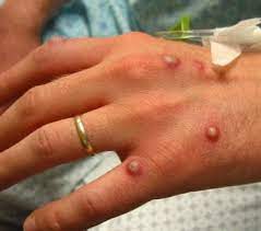 It is a rare but potentially serious viral illness that is characterised by . Monkeypox Background Pathophysiology Etiology