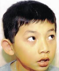 Image result for nevus sclerae