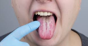 Image result for cancer tongue symptoms)