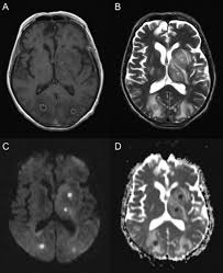 Image result for Brain Lesion