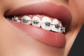 Different Kinds Of Retainers Orthodontic Treatment Wow Internacional