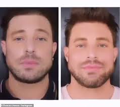 Check spelling or type a new query. Duncan James Reveals He Has Had Filler Injections In His Jaw Duk News