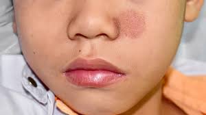 Image result for Eczema nummulare