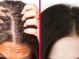 How To S Wiki 88 How To Get Rid Of Dandruff For Good