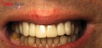 Le Dechaussement Des Dents
