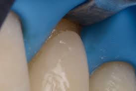 Css gap works in css grid, but there are many cases where we have inline lists that need space without a defined grid. The Closing Gap Technique The Perfect Seal In Class 5 Restorations