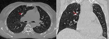 Image result for Broncholithiasis