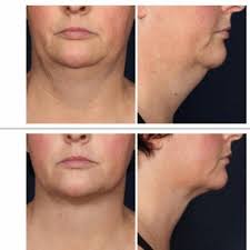 Kybella Before And After Pics Kybella Neck Lift Injectables Fillers