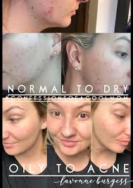 Oily skin tips for better skincare