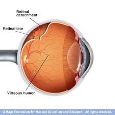 Retinal Detachment Detachment Eye Facts Posterior Vitreous Detachment