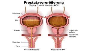Die entscheidung, ob du eine prostatauntersuchung brauchst. Urologe Region Hannover Prostatauntersuchung Urologe Region Hannover Urologe Region Hannover