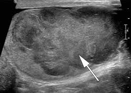 They travel through the body and bounce back to the transducer. Testicular Seminoma And Its Mimics From The Radiologic Pathology Archives Radiographics