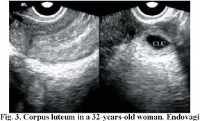 Image result for corpus luteum sonography)