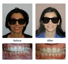 Before After Braces Photos Significance Orthodontics