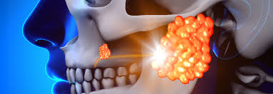 Image result for Sialolithiasis