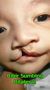 Pengertian dan Jenis Sumbing Bibir Bilateral