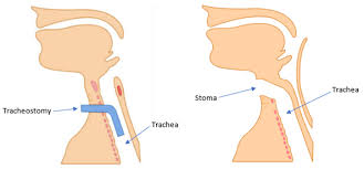 Image result for Tracheostomy